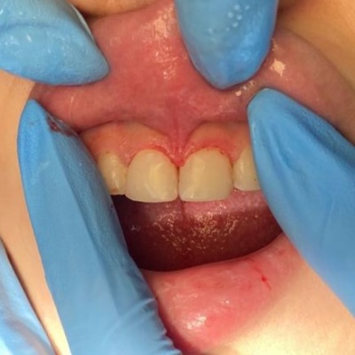 Реставрация передних зубов - результат