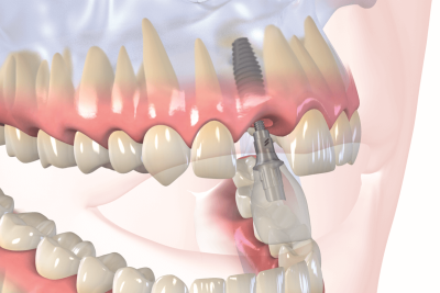 Одномоментная имплантация: установка абатмента с коронкой на передний зуб