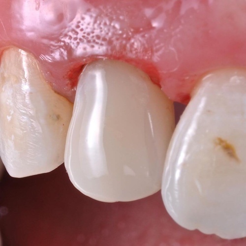 Восстановление зуба после кариеса