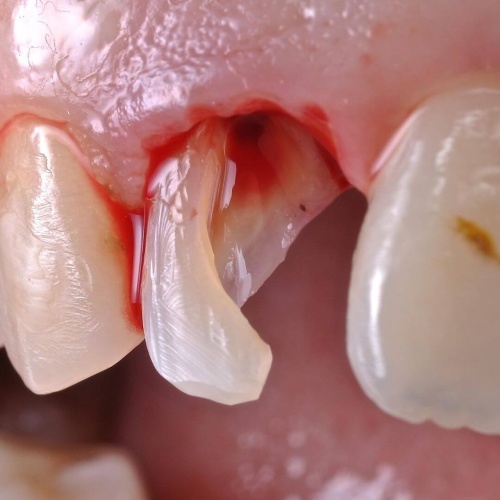 Разрушенный зуб до восстановления