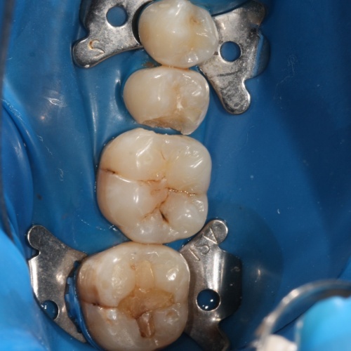 Зубы до лечения кариеса