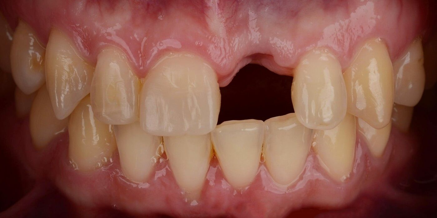 До: состояние зубного ряда