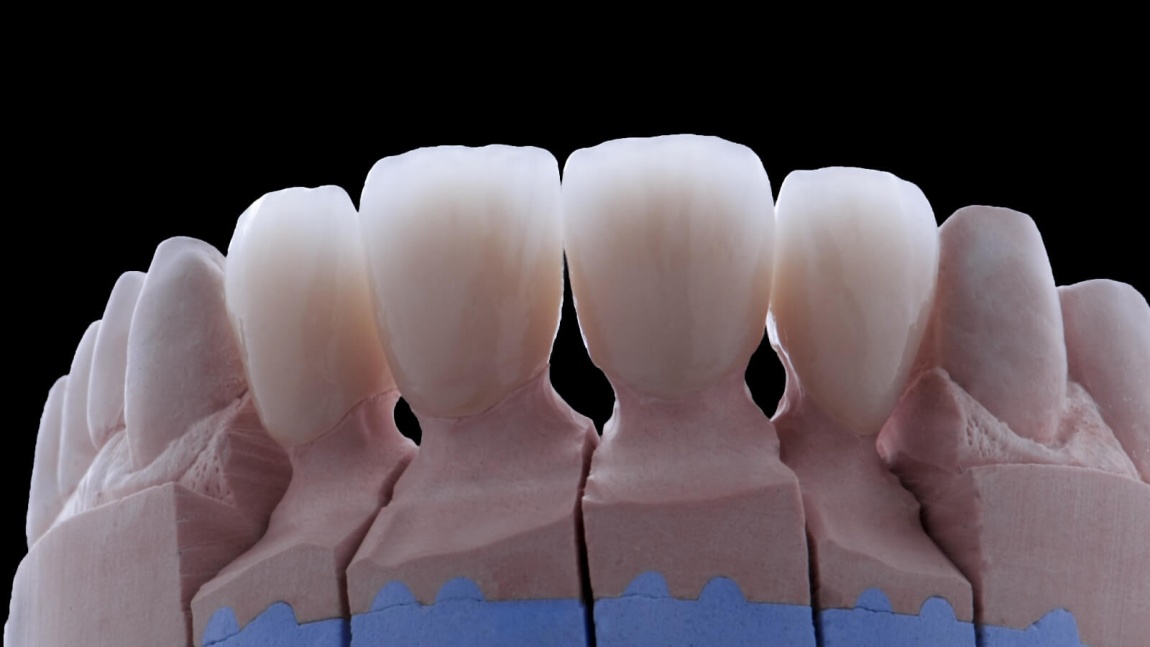 Керамическое протезирование зубов