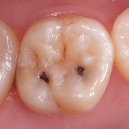 Кариес жевательного зуба