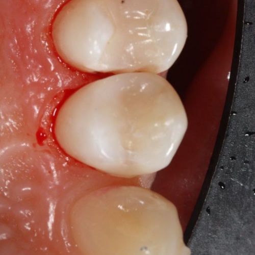 Восстановленный зуб