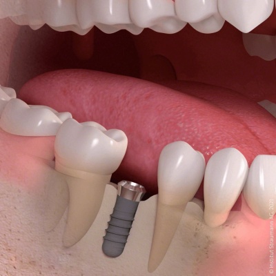 Зубной имплант фото