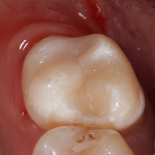 Восстановленный зуб