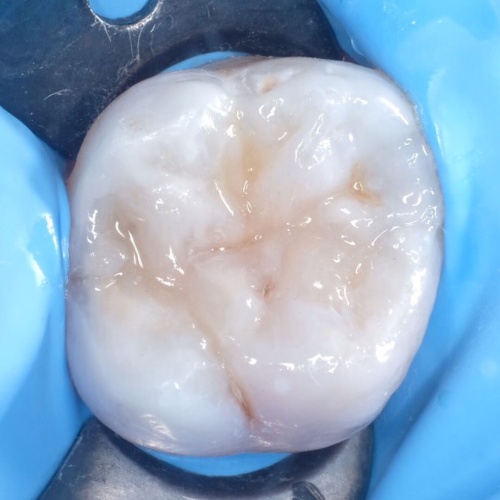 Лечение кариеса жевательного зуба