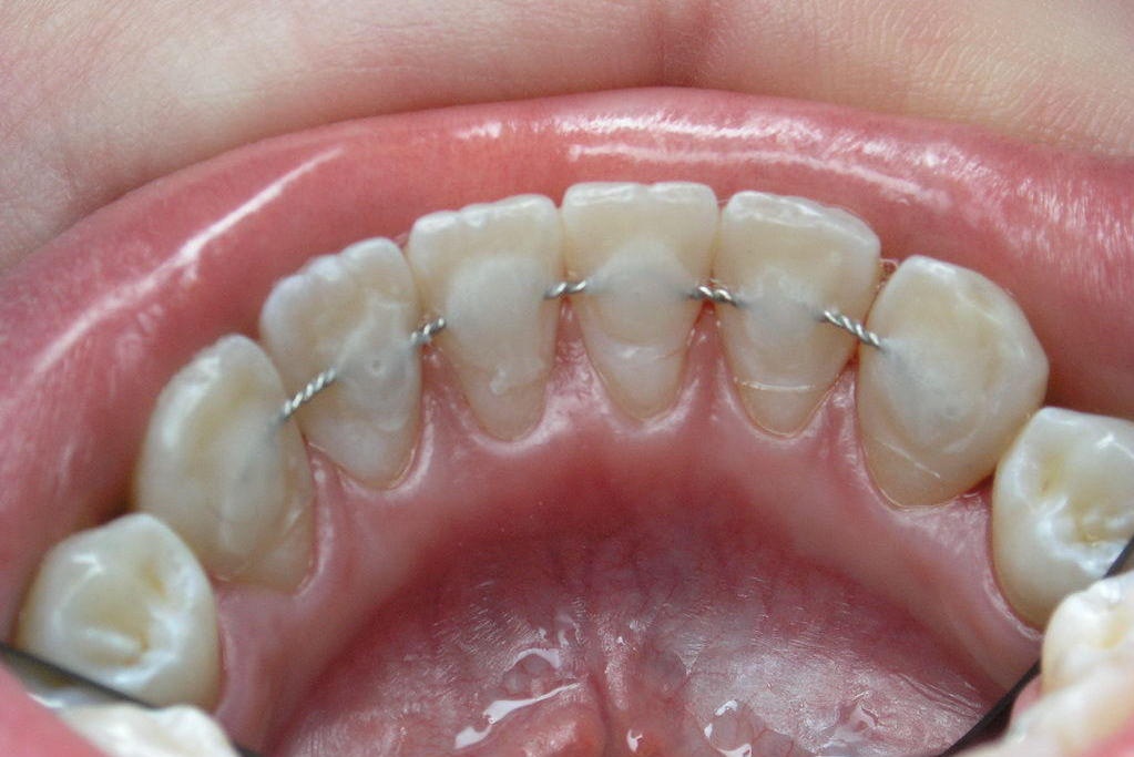 Шинирование подвижных зубов 