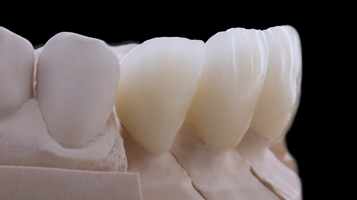 Протезирование зубов керамикой